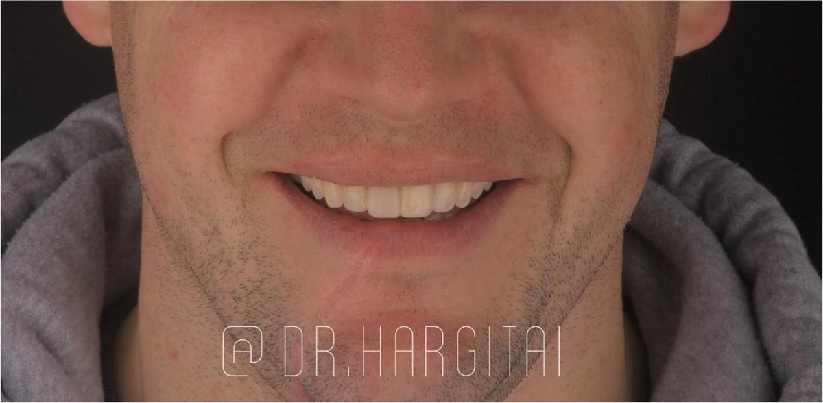 Smile restored with a dental bridge at Bespoke Dental