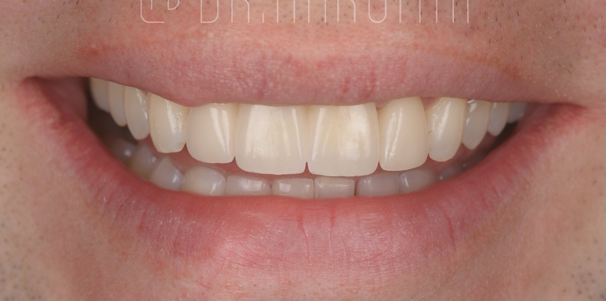 Front teeth restored with a dental bridge at Bespoke Dental