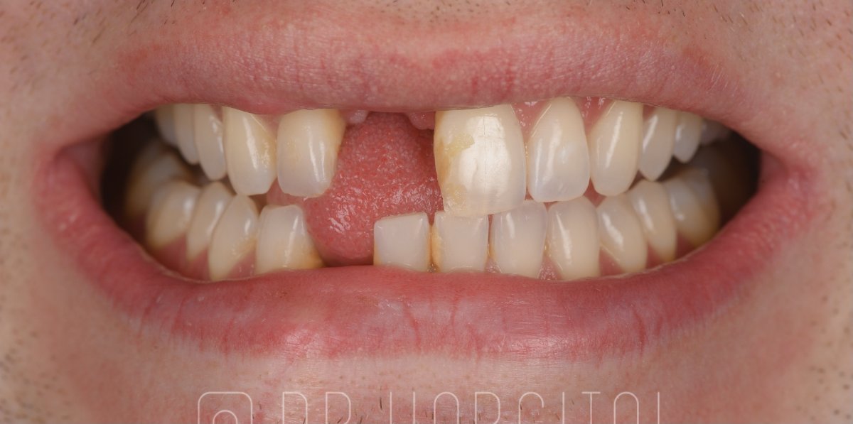 Missing front teeth before a dental bridge at Bespoke Dental