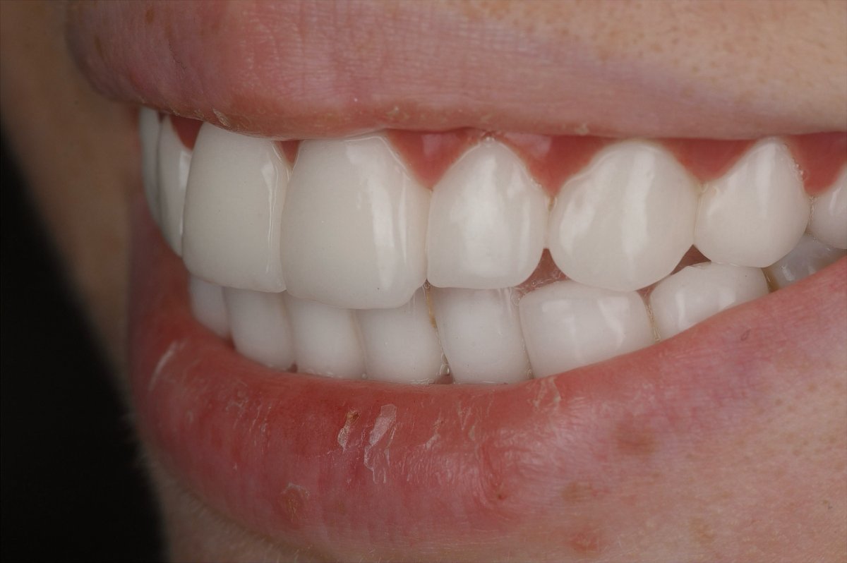 Teeth before dental crown treatment at Bespoke Dental