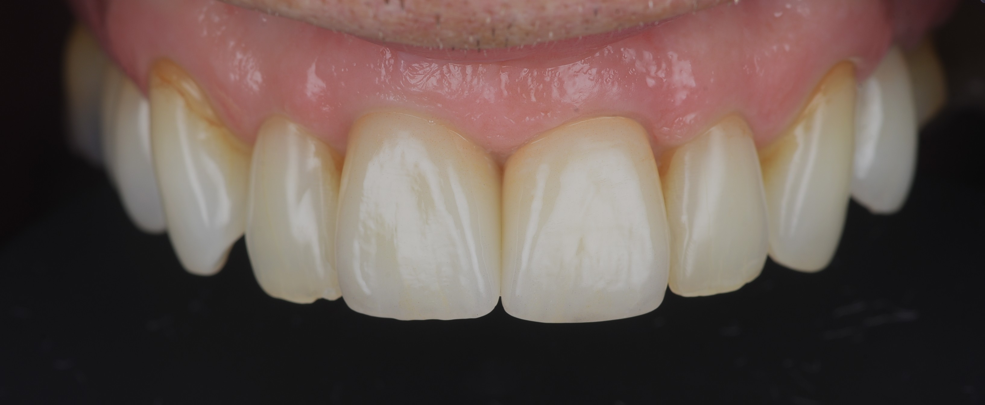 Front tooth restored with an immediate implant at Bespoke Dental