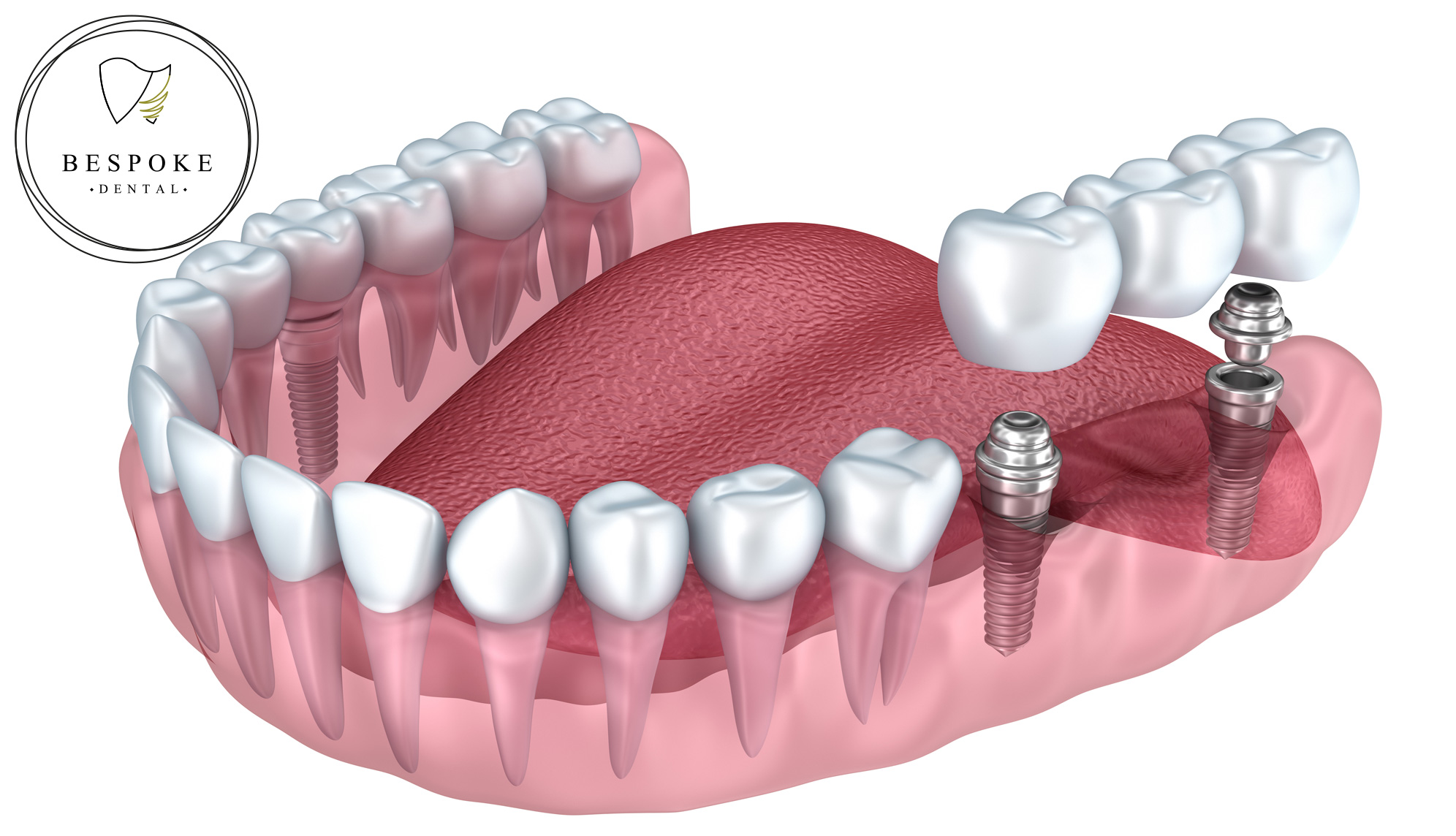 Multiple tooth dental implant treatment