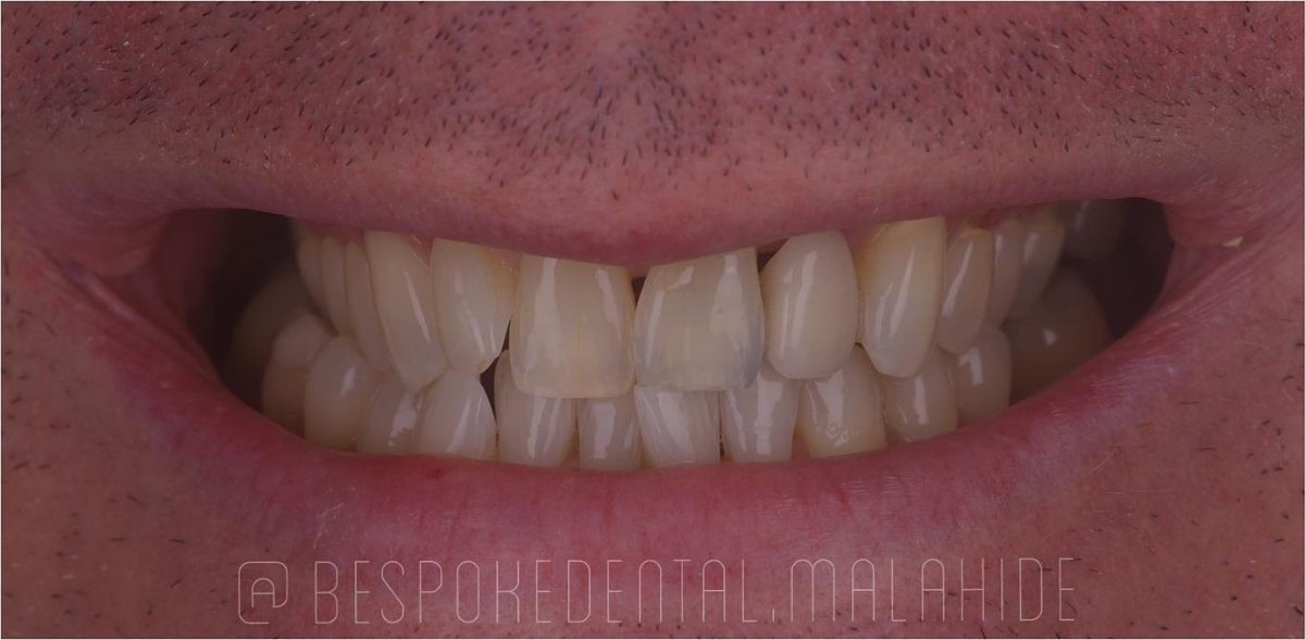 Smile before porcelain veneers at Bespoke Dental