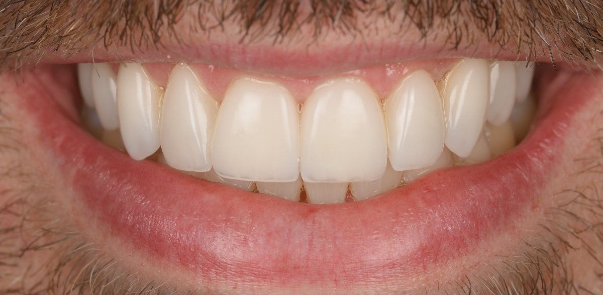 Smile after porcelain veneers at Bespoke Dental
