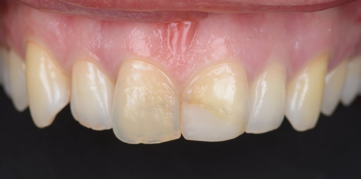 Smile before porcelain veneers at Bespoke Dental